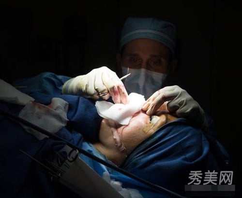 Một ca gọt cằm của cô gái trẻ.