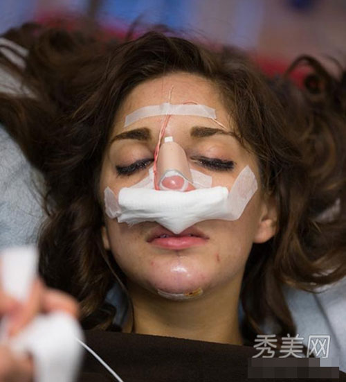 Thời gian để có thể trở lại bình thường là từ 4-6 tháng.