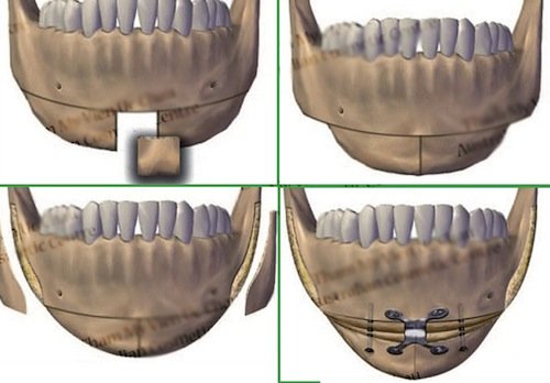 Cấu trúc xương hàm thay đổi sau khi gọt cằm.
