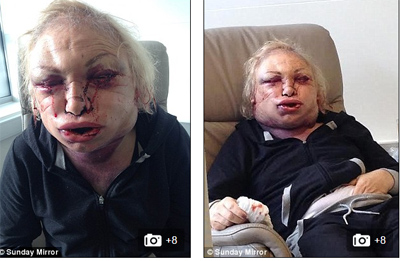 Vì muốn mình trông nữ tính, xinh đẹp và quyến rũ hơn, Kellie Maloney đã tới một trung tâm thẩm mỹ để thực hiện hàng loạt ca Shbet888 tiền thưởng cực khủng chỉnh hình gương mặt như nâng mũi, cắt mắt, bóp má, làm cằm, nâng cơ mặt.