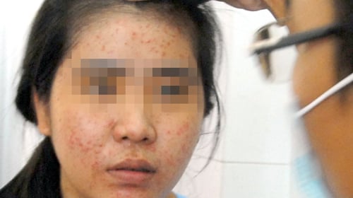 Rất nhiều các dị ứng do dùng kem trộn.