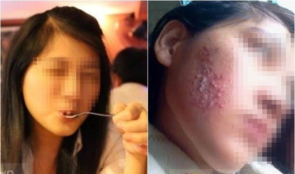 Đấy là do nhiễm trùng trong quá trình dùng mỹ phẩm.