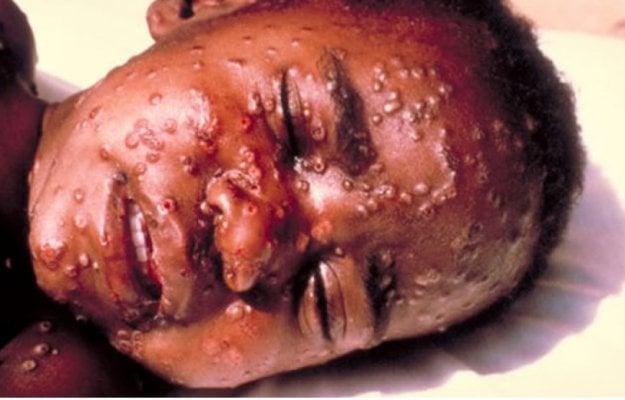 Bệnh do virus Ebola hay còn được biết đến như bệnh sốt xuất huyết do virus Ebola, được phát hiện lần đầu tiên tại Sudan và Cộng hòa Congo vào năm 1976.
