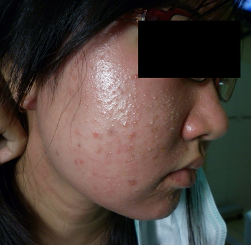 Kem trộn không nguồn gốc rõ ràng dễ gây nổi mụn.