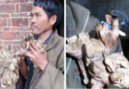 Bị căn bệnh 'quái ác' hoành hành, người đàn ông Trung Quốc phải mang trên mình hình dáng đáng sợ, ảnh hưởng đến Shbet16 chơi game trực tuyến hàng ngày của anh ta.