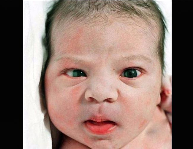 Đó là điều hoàn toàn bình thường. Phải mất 4 tháng, hai mắt của bé mới hoàn toàn có thể hoạt động nhất quán.
