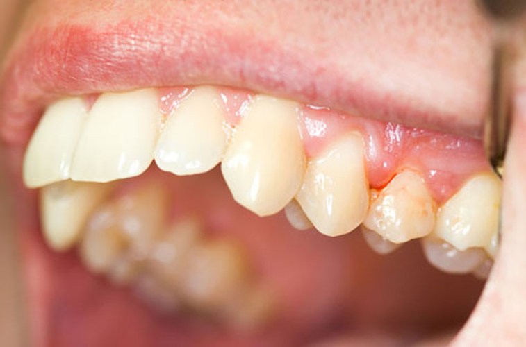 Phần lớn chúng ta đều biết rằng thuốc lá có hại cho sức khỏe, nhưng chúng ta chưa biết một cách chắc rằng hút thuốc cũng là nguyên nhân chính dẫn đến nhiều vấn đề về răng miệng.