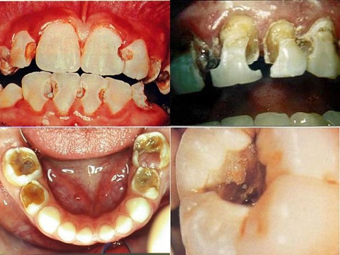 Thuốc lá cũng làm phá hủy tổ chức lợi dẫn đến hở chân răng. Điều này làm cho răng dễ bị sâu và nhạy cảm với nóng và lạnh .