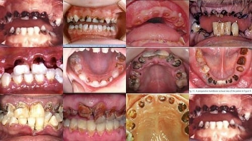 Thuốc lá làm cho các răng bị nhiệm mầu mà không thể làm sạch bằng cách đánh răng thông thường.