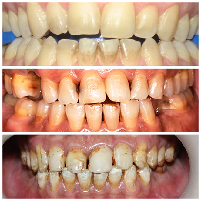 Thuốc lá cũng là nguyên nhân tăng lắng đọng cao răng đòi hỏi phải lấy cao răng thường xuyên.