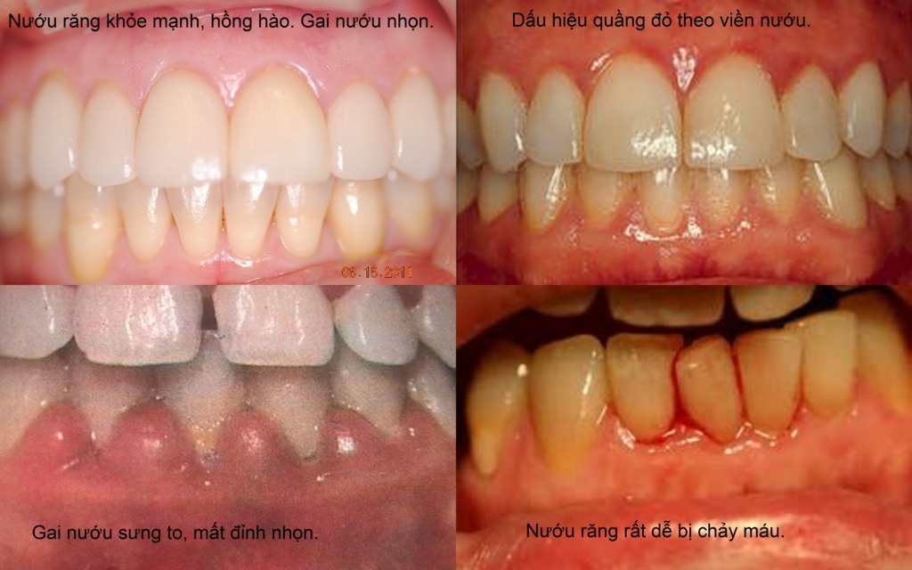 Thuốc lá cũng làm tăng nguy cơ mắc bệnh nướu lợi - một trong những nguyên nhân dẫn đến mất răng ở người lớn.