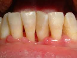 Hút thuốc cũng làm chậm lại quá trình liền vết thương sau nhổ răng hoặc Shbet888 tiền thưởng cực khủng khác trong miệng.