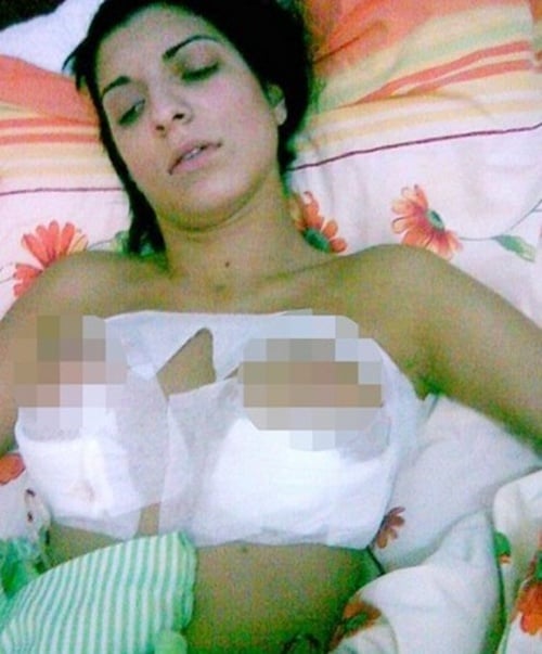 Cựu MC nổi tiếng Andreea Tonciu cũng bị hỏng ngực.