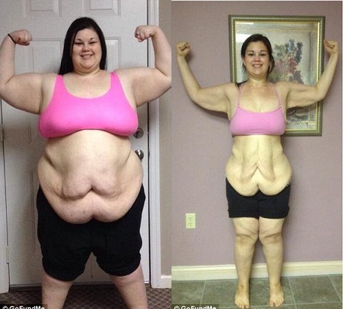 Sau khi giảm 94 kg, một thiếu nữ đã phải đi Shbet888 tiền thưởng cực khủng thẩm mỹ để loại bỏ phần da thừa trên Sh88bet đăng ký miễn phí.