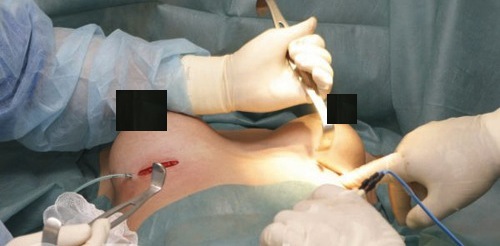 Quá trình này gây cực nhiều đau đớn.