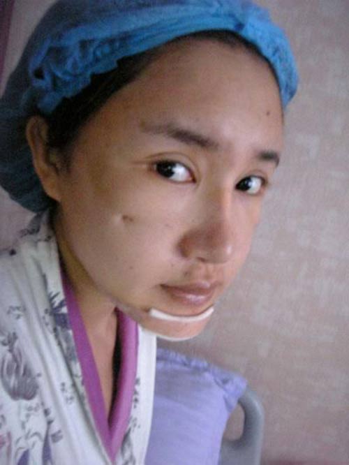 Sau khoảng 1 tháng mí mắt sẽ liền.