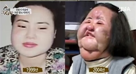 Khuôn mặt phì nộn vì tiên boxton.