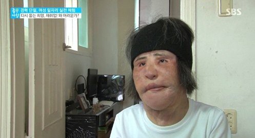 Cô liên tiếp đến viện và tự bơm nhiều chất vào da tại nhà.