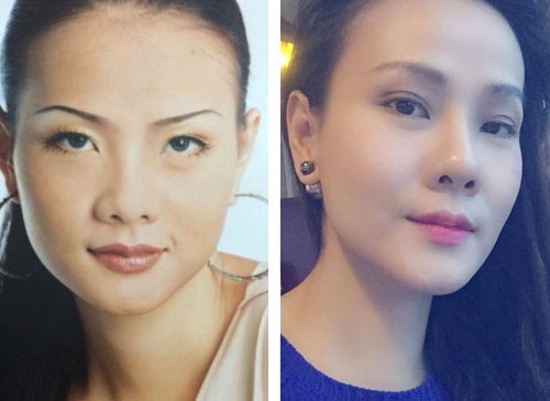 Dương Yến Ngọc thừa nhận nâng mũi