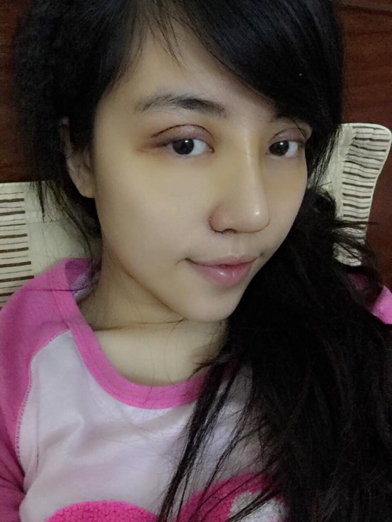 Mắt của cô sưng phồng sau khi thẩm mỹ.