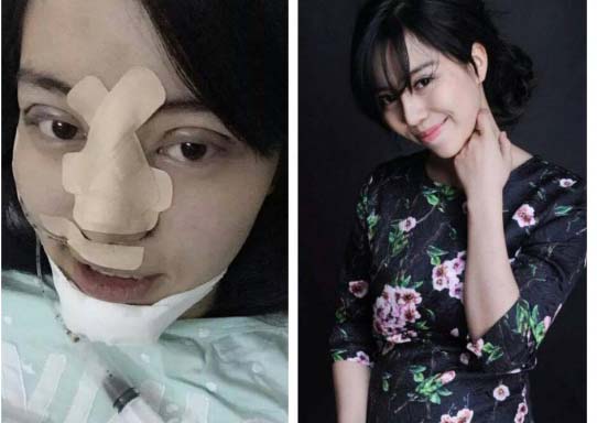 Hotgirl Việt thẩm mỹ toàn bộ khuôn mặt vì sợ chồng 