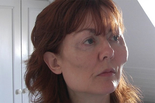 Cô Alex Laird (53 tuổi) đến từ Ai Len 8 năm trước đã có một quyết định để lại hậu quả nghiêm trọng, đó là việc tiêm chất làm đầy filler vào mặt để trông xinh đẹp, tươi tỉnh và phúc hậu hơn.
