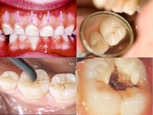 Sâu răng, chậm mọc răng canxi cũng là một thành phần quan trọng của răng. Do dó, thiếu hụt canxi trong Sh88bet đăng ký miễn phí cũng ảnh hưởng đến răng, gây sâu răng. Trẻ em thiếu canxi có thể mọc răng trễ hơn so với các bé cùng tuổi.