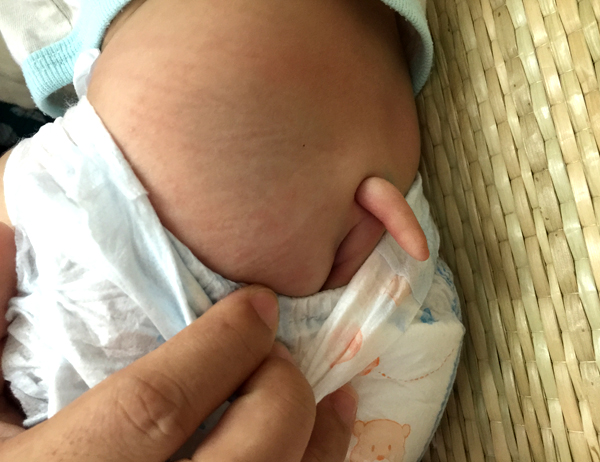 Hãi hùng bé gái 7 tháng tuổi ở Cần Thơ mọc