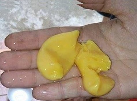 Hoang mang: Trứng vịt có lòng trắng bám 