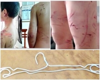Nghi con trộm tiền bà, dùng móc sắt đánh thương tích đầy người