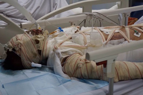 Xót xa người mẹ trẻ nguy kịch vì lao vào nhà cháy cứu 2 con