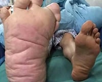 Chàng thanh niên có bàn chân phải to gấp 3 lần chân trái