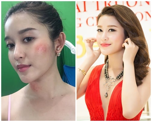 'Sốc' với khuôn mặt bầm tím của Á hậu Huyền My