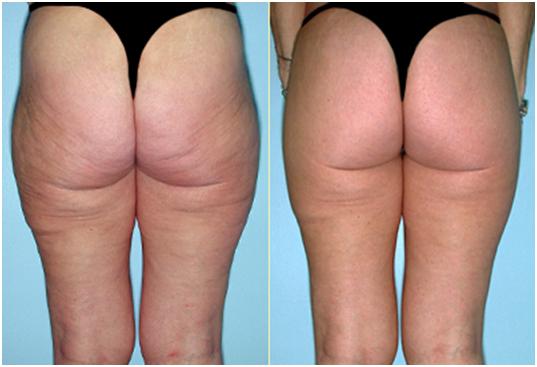 Vòng 3 cũng kém săn chắc và bị chảy xệ.