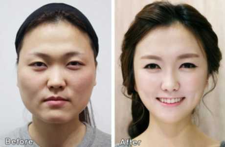 Phẫu thuật thẩm mỹ - đẹp nhưng lắm nỗi lo!