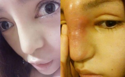 Chiếc mũi sưng như vòi voi trông rất đáng sợ.