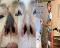Những ca hoại tử vì thẩm mỹ kinh hoàng nhất thế giới
