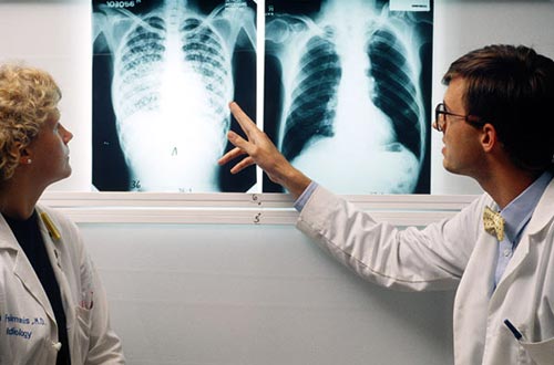 Dấu hiệu cảnh báo bạn bị bệnh lao phổi