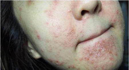 Khuôn mặt phổng rộp vì kem chống nắng
