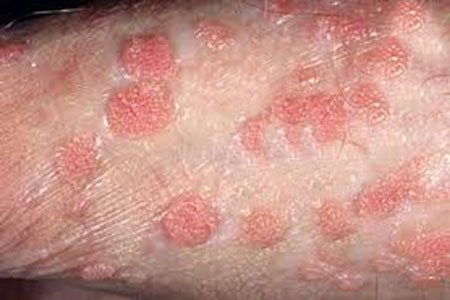Mắc sùi mào gà từ ông chủ, thiếu nữ hốt hoảng vì loét miệng