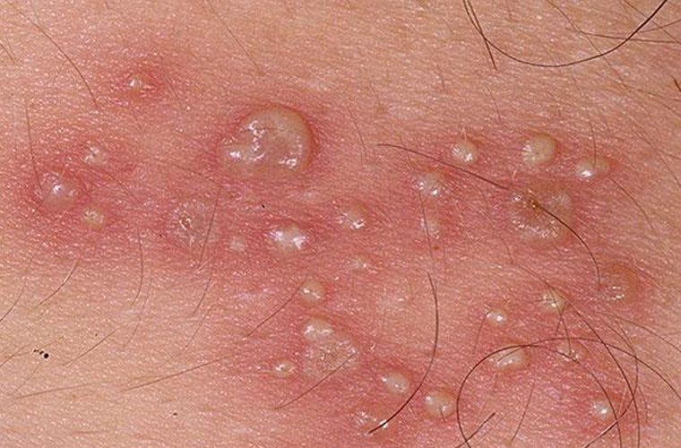 Đau đớn khi chồng đi tiếp khách mang sùi mào gà về 