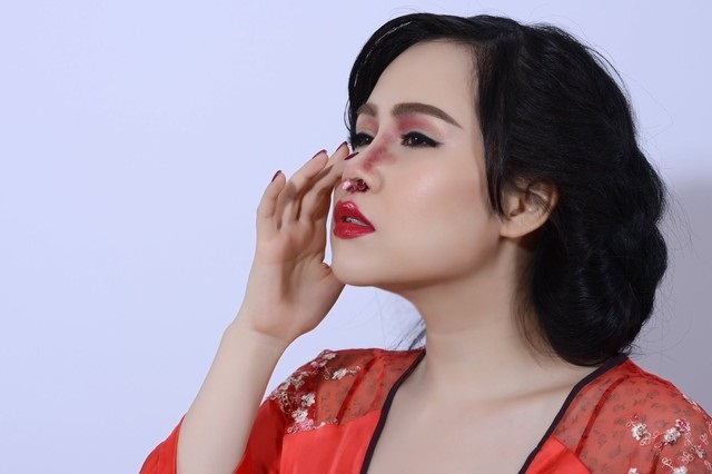 Mũi sưng tím, đau đớn sau quá trình nâng.