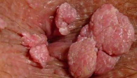 Đau đớn: “Chồng em hiền lành lắm sao mắc sùi mào gà được”