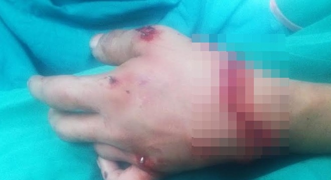 Cưa gỗ, nam thanh niên cưa đứt lìa bàn tay của mình
