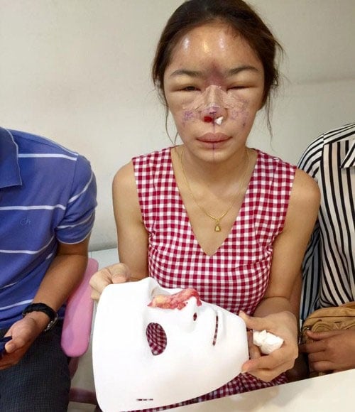 Mới đây, một cô gái xinh đẹp ở Thái Lan đã công khai những hình ảnh chụp chiếc mũi hỏng do biến chứng Shbet888 tiền thưởng cực khủng thẩm mỹ của mình.