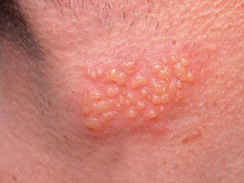 Bác sĩ kêu trời vì bệnh nhân để sùi mào gà 
