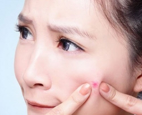 Sự thật không phải ai cũng biết về mụn trứng cá