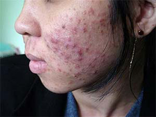 Rước bệnh vì dùng mỹ phẩm trôi nổi giá rẻ