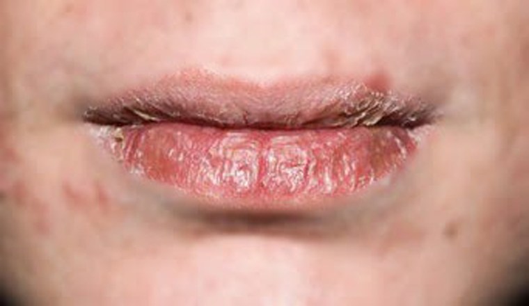 Mồm miệng lở loét vì tẩy da chết cho môi