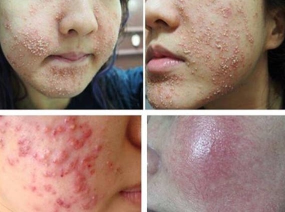 Kinh hoàng với mỹ phẩm làm trắng da cấp tốc